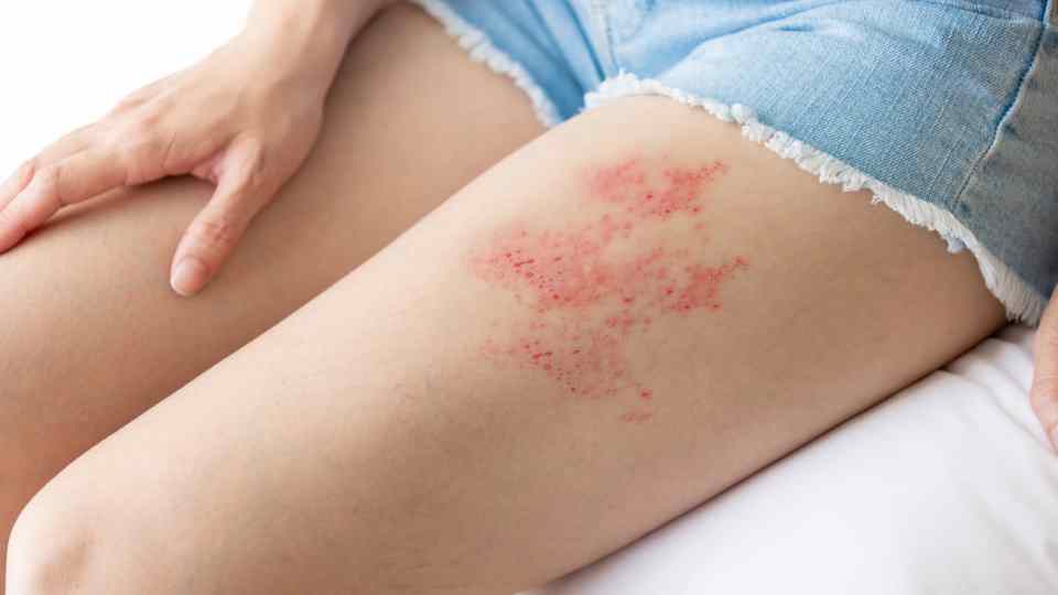 Understanding Shingles: Symptoms, Treatment, and Relief